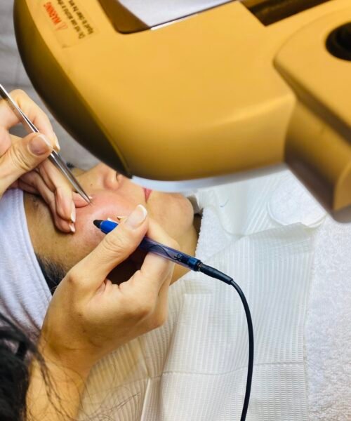 electrolysis hair removal delft treatment on face